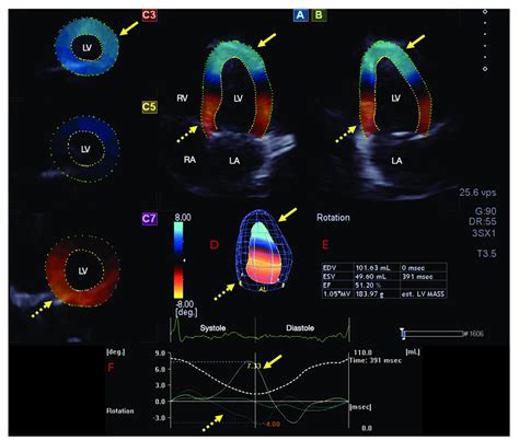 3d volumetric lv volumes|3D echocardiographic reference ranges for normal left ventricular .